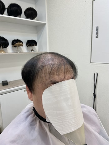 탑, 정수리 탈모 BEFORE