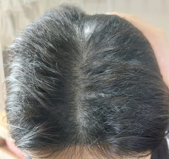 씻고 나와서 얼마 지나지 않은 채로 찍은 사진이라 머리가 약간 젖은 상태입니다. 머리에 스탠드를 갖다대고 찍은 사진이구요. 지금 오른 쪽 부분은 제가 손으로 잡고 누른 거고, 왼쪽은 냅둔 건데 확실히 곱슬곱슬하면서 위로 뜨려고 하는 게 보이시죠? 그리고 SMP 시술 받은 것도 자세히 보시면 보입니다.