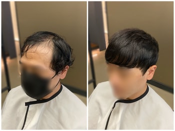 6000모 쿠션증모술 후기