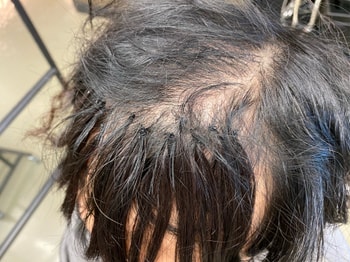 다른곳에서 증모술시술