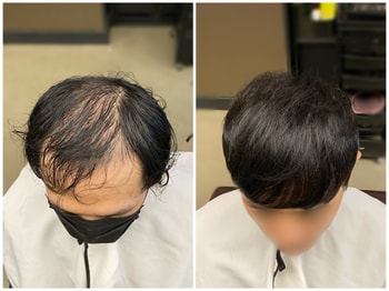 6000모 쿠션증모술 후기