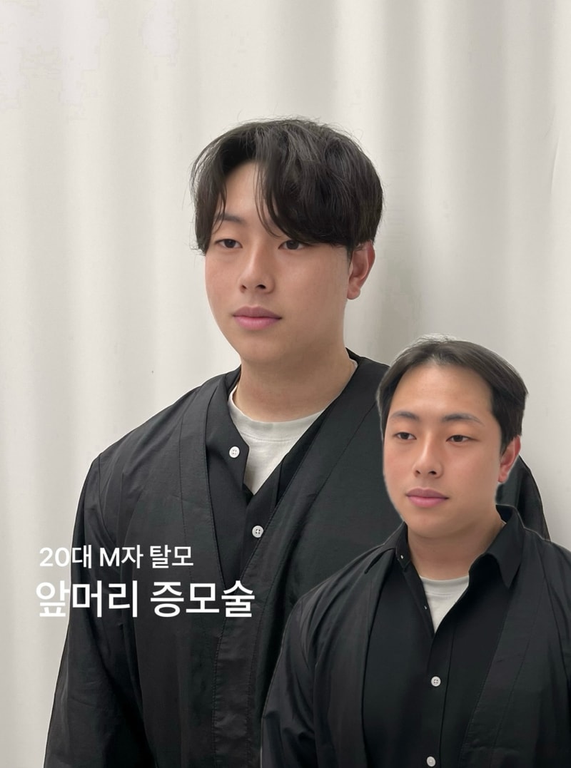 20대 탈모인 여기보세요~~~~~~~~~~~~!!
