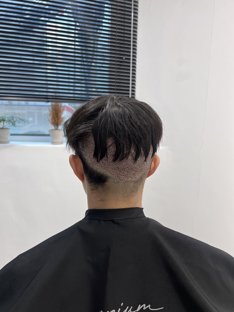 모발이식 후 붙임머리했어요!