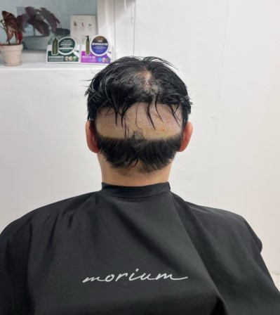 비절개 모발이식 후 뒷머리 붙임머리