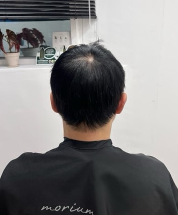 모발이식 붙임머리 후
