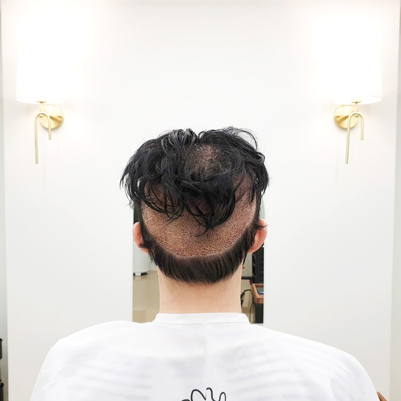 대량 비절개 모발이식 후두부 삭발 부분 가발