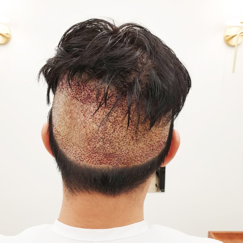 비절개 모발이식 뒷머리 삭발 커버