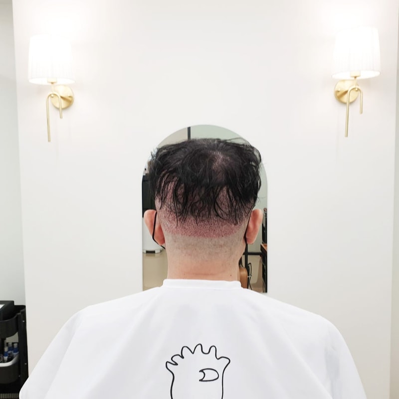 비절개 모발이식 투블럭 삭발 붙임머리