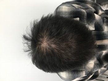 뉴헤어 성형외과에서주사 치료전 