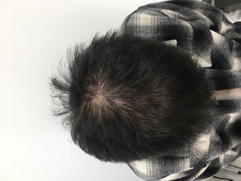 뉴헤어 성형외과에서주사 치료전 