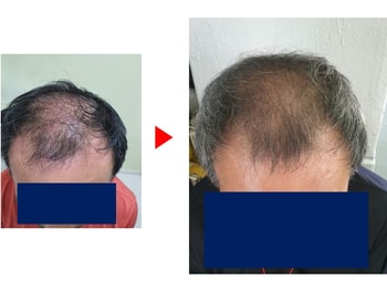 탈모전후사진1