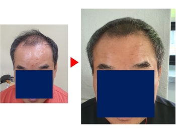 탈모전후사진2