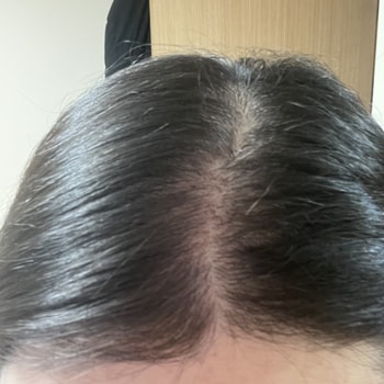 3회차 치료 후