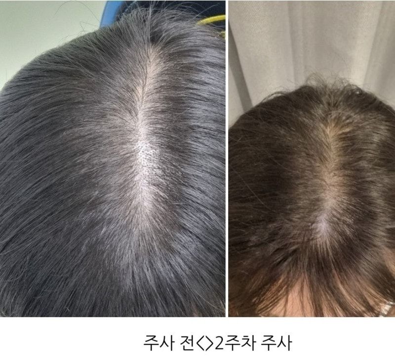 여성탈모