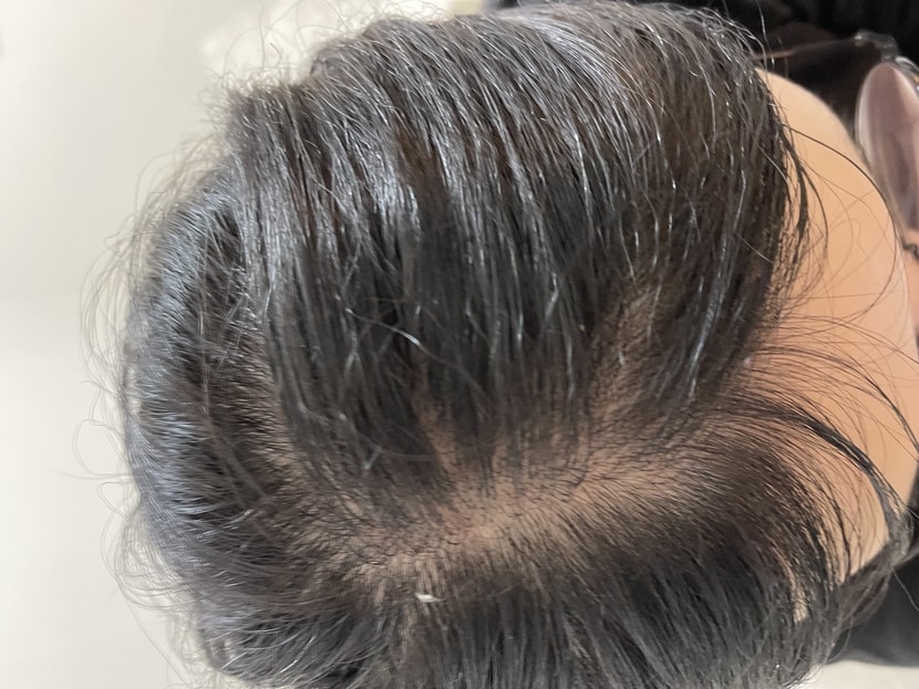 이 사진은 정확히 치료 1시간 전에 찍은 두피 사진! ㅋㅋㅋ 사진으로 봐도 듬성 듬성 비어있는게 보이조 .... ㅠ ㅠ 