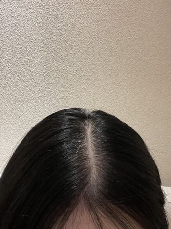 요 사진은 세번째 치료 후 !!!! 진짜 확실히 계속 좋아지고 있는 게 보여서 치료가 효과가 있구나 싶었던 .. 