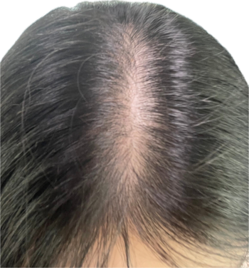 치료전 사진 2 ,, 두피가 숭덩숭덩 가르마 탈모는 진짜 사람이 없어보기에 하는 고런 ????????