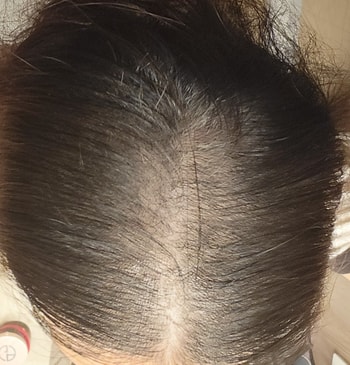 치료시작후 2개월쯤..쉐딩이 거의 끝나갈무렵이에요 머릿결도 풀락거리네요ㅜ