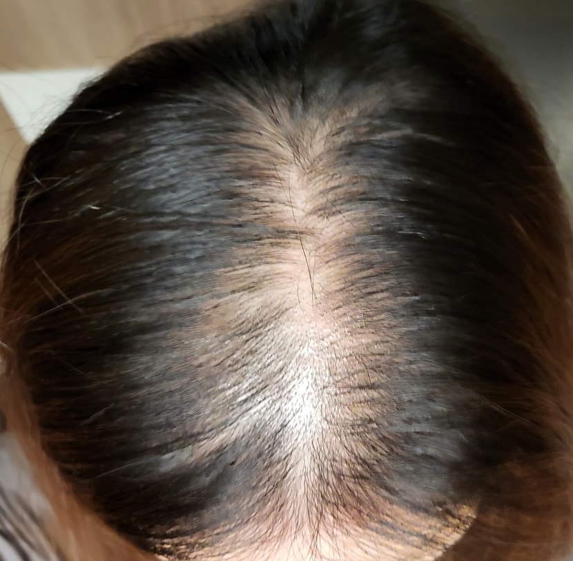 치료시작후 1개월쯤?