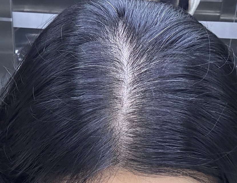 3회차 시술후 6일차 밝은빛