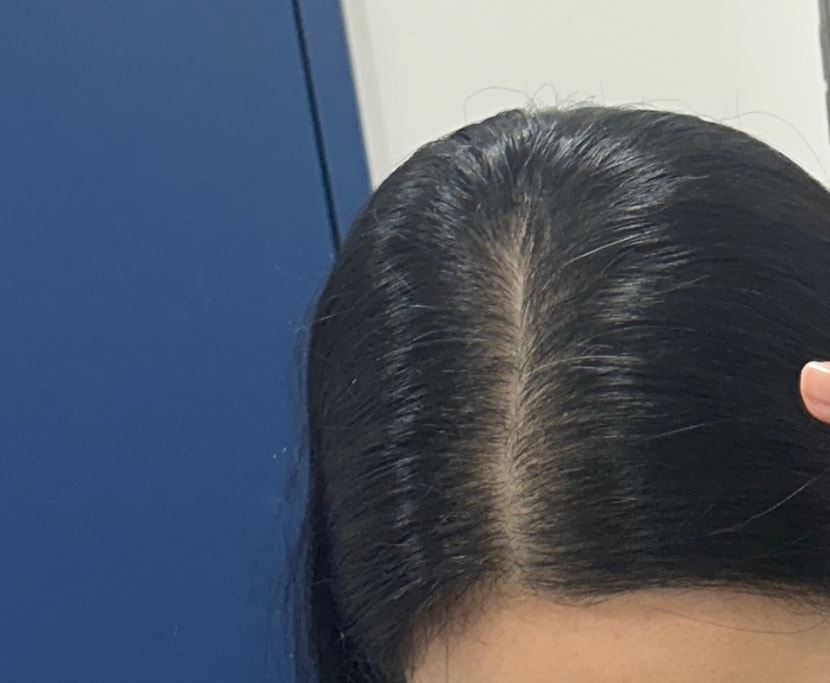 3회차 시술후 6일차 일반빛