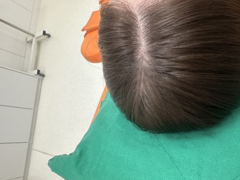 치료하고 머리 말린 후 사진 이에요 ㅎㅎ