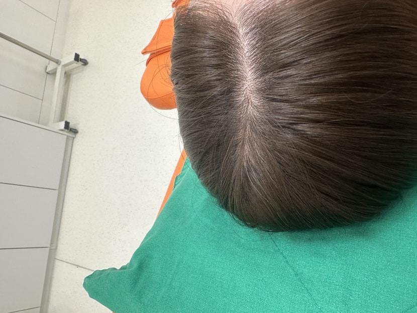 치료하고 머리 말린 후 사진 이에요 ㅎㅎ