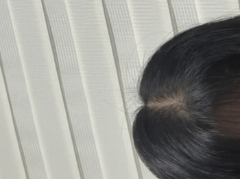 시술 후 머리 말린 후