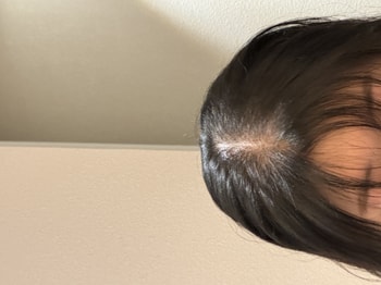 치료 후 바로 찍은 사진(말리기전입니다)