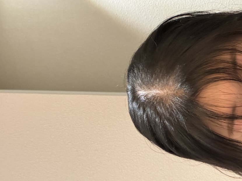 치료 후 바로 찍은 사진(말리기전입니다)