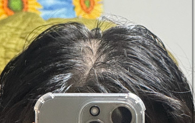 치료 후 다음날 찍은 정수리사진입니다..