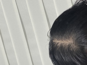 시술 후 머리 말리기 전!