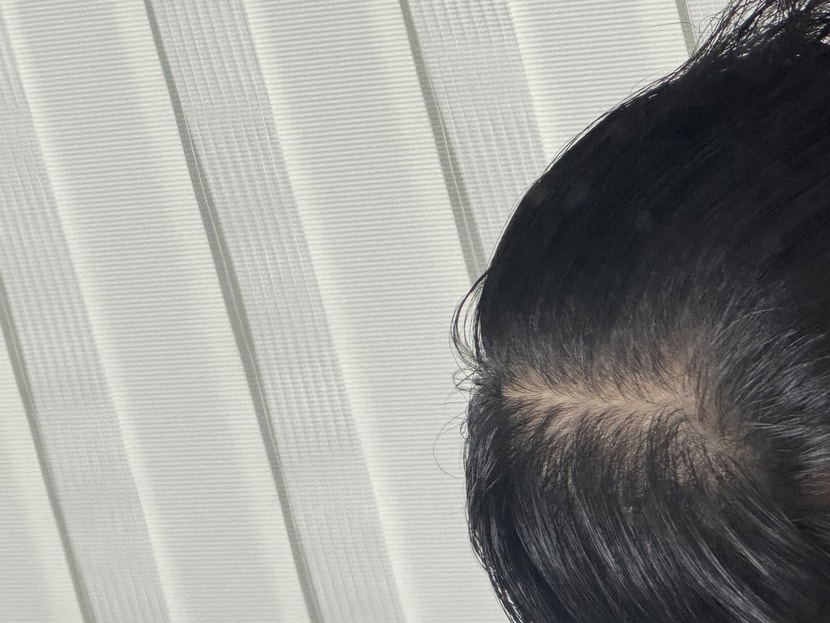 시술 후 머리 말리기 전!