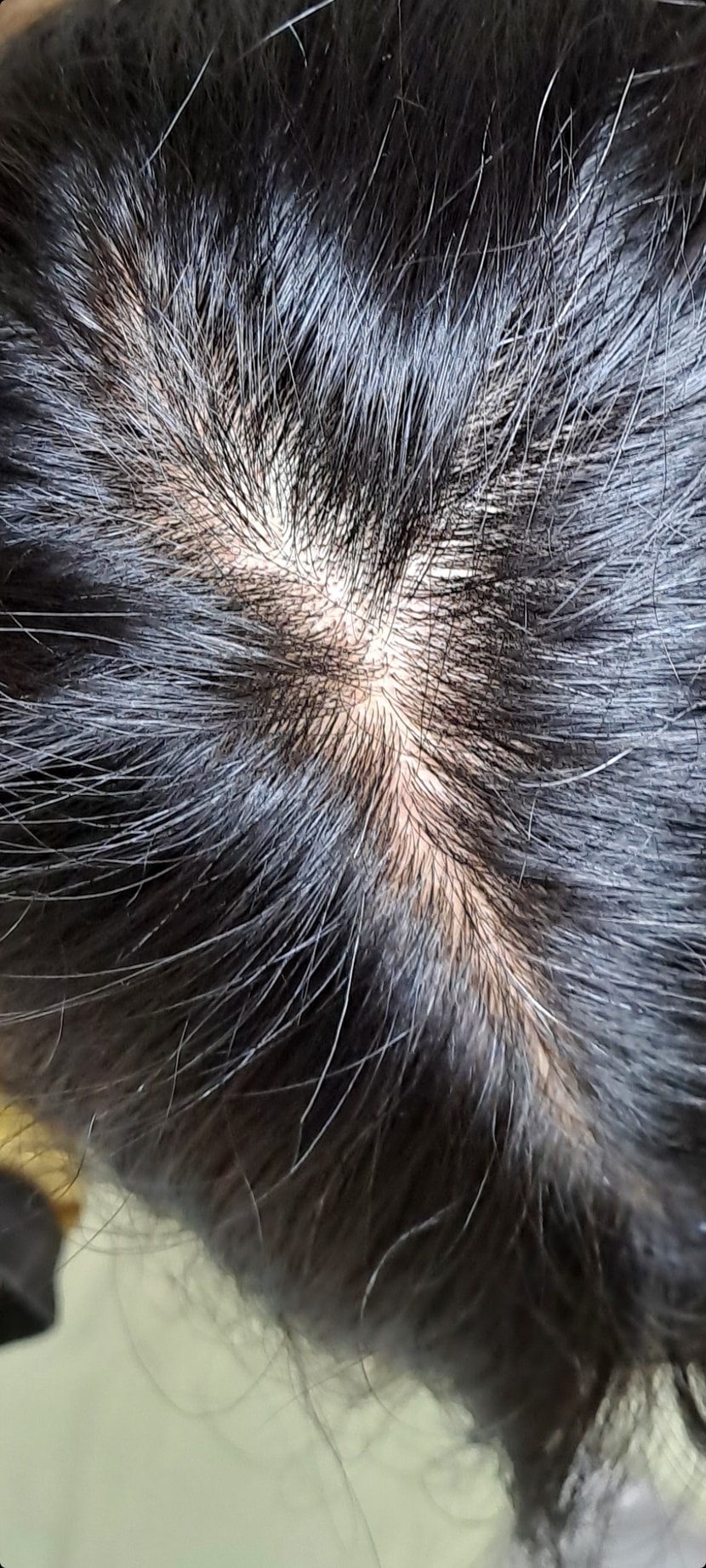 4.5월( 머리감을 때마다 엄청 빠짐).앞머리까지 가르마가 생김