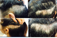 모발이식 동반탈락및 부작용