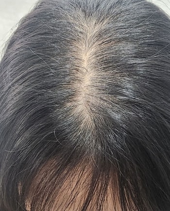 시술전 