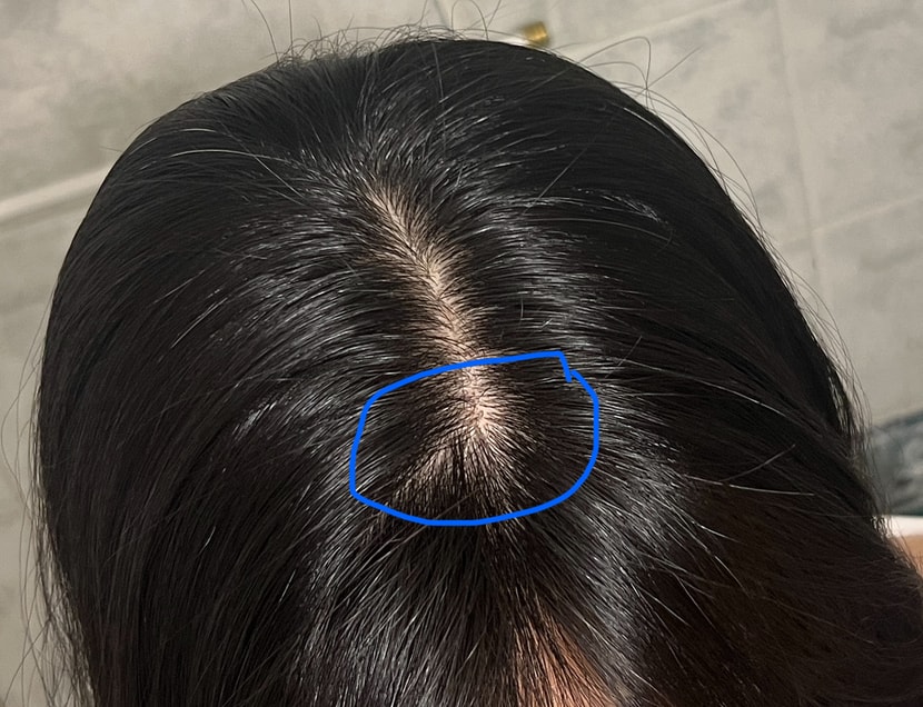 24년 5월 현재 정수리 가운데가 갈라짐