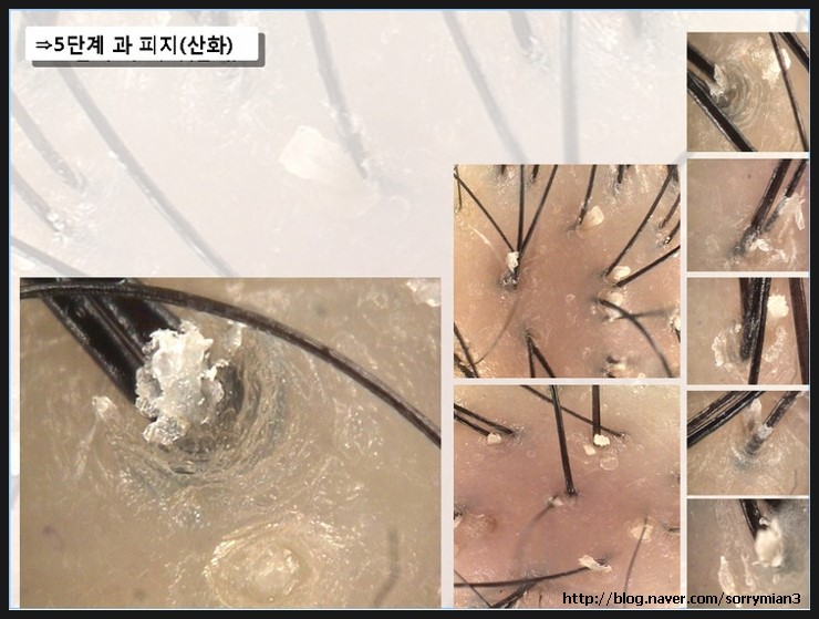 이건 두피현미경사진. 제 두핀 아닌데  저렇게 막혀 있어요. 약간 건조할때도 있고 약하게 기름끼가 있을때도 있고..빠진 머리 끝보면 사진에서 보이는 하얗거나 약간 노란 피지알갱이 붙어있어요.ㅠ.