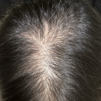 5회차 시술 후(쉐딩)