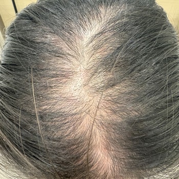 5회차 시술 직후