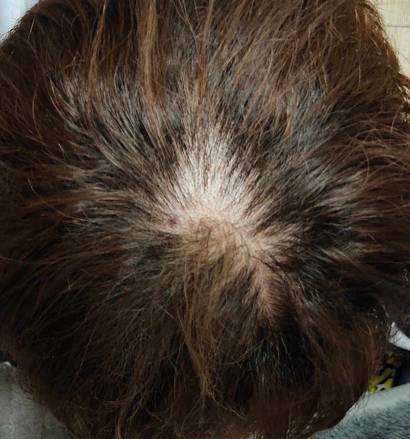 비슷한시기 염색하고 머리개털됨 