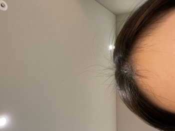 시술 직후 힘을 얻은 잔머리들 ..