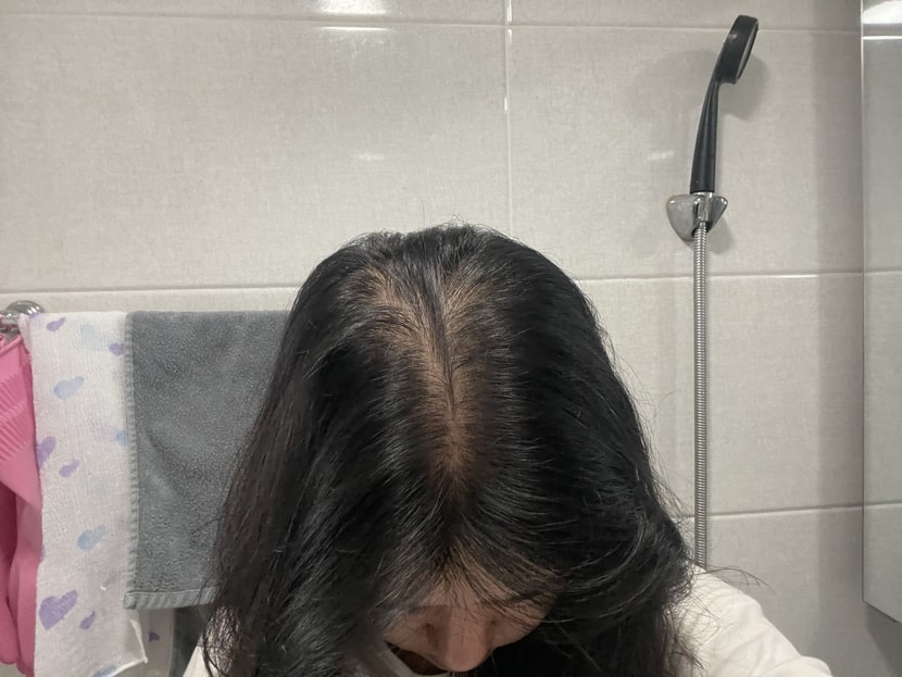 시술 후 4일 뒤 정수리사진