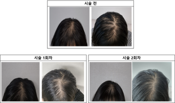 시술전 / 시술 1회차 / 시술 2회차