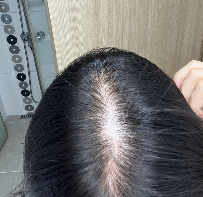 치료전 정수리