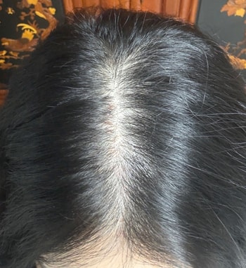 시술받고 집와서 찍은 1회차 사진입니다! 두피가 붉긴하네요ㅎㅎ 받고 나서 병원에서 확인했는데 피는 안났습니다 ㅎㅎㅎ