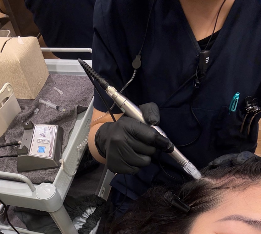 모낭강화주사 시술중 사진입니다. 저걸로 두피를 상처내고 용액을 발라서 흡수시키는것 같아요. 좀 아프긴한데 참을만합니다