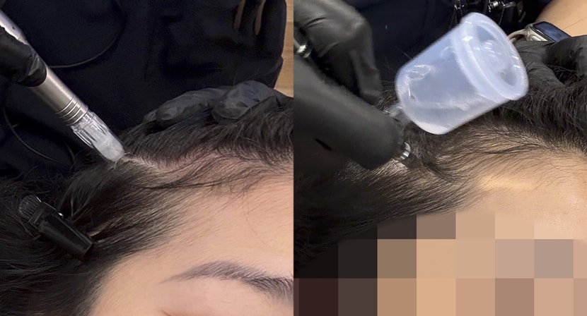 애교머리쪽 일주일 변화입니다. 비었던곳이 조금 채워졌어요!