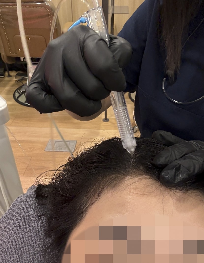 스티머한후 산소제트필로 각질을 벗겨내요. 이건 그냥 물로 가볍게 밀어내는 느낌입니다.