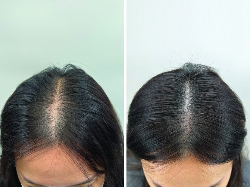 왼쪽이 두피문신 받기 전  / 오른쪽이 며칠 전 리터치 후에요~